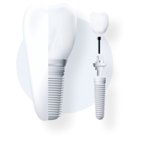 dental implants - implant dentist in Manhattan, KS